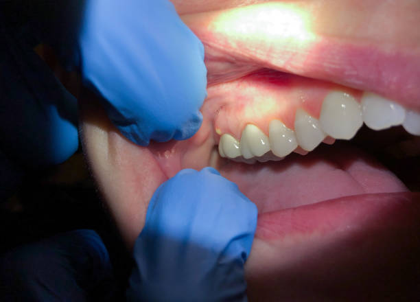 Best Emergency Gum Pain Relief  in Mcdonald, OH